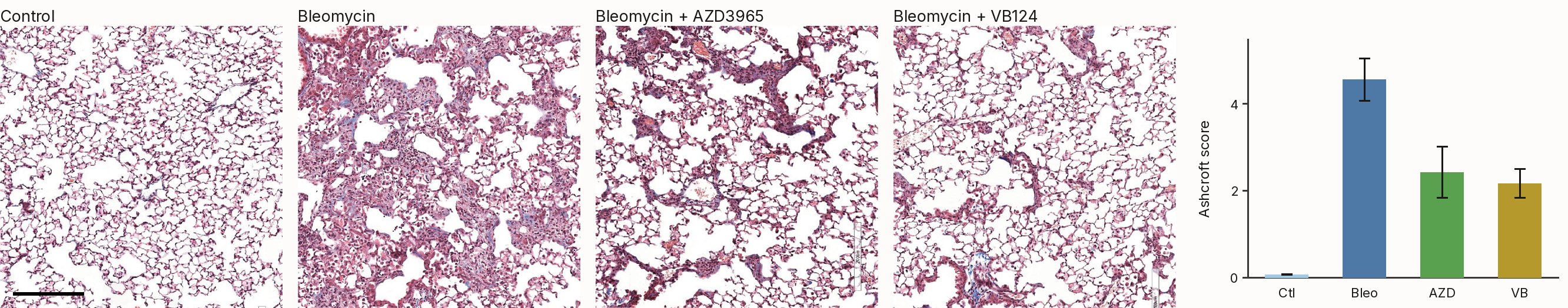 Four trichrome-stained mouse lung sections — control, bleomycin, bleomycin with AZD3965, and bleomycin with VB124 — beside a bar plot of Ashcroft fibrosis scores for the same four groups.